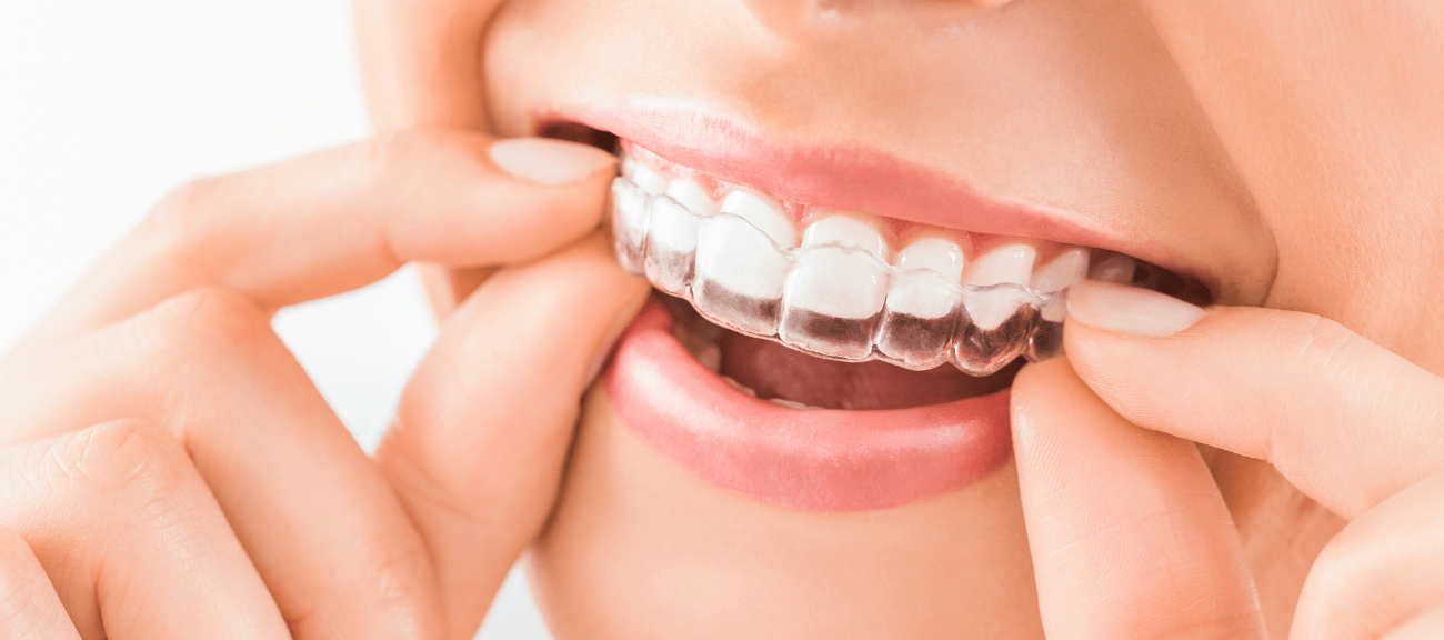 Invisalign - Nevidni zobni aparat