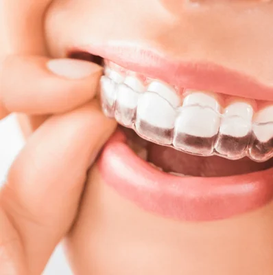 Invisalign - Nevidni zobni aparat