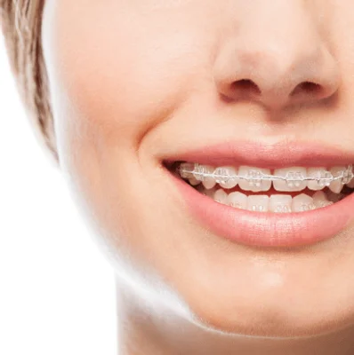 Nesnemni ortodontski aparat