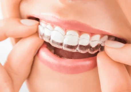 Invisalign - Nevidni zobni aparat